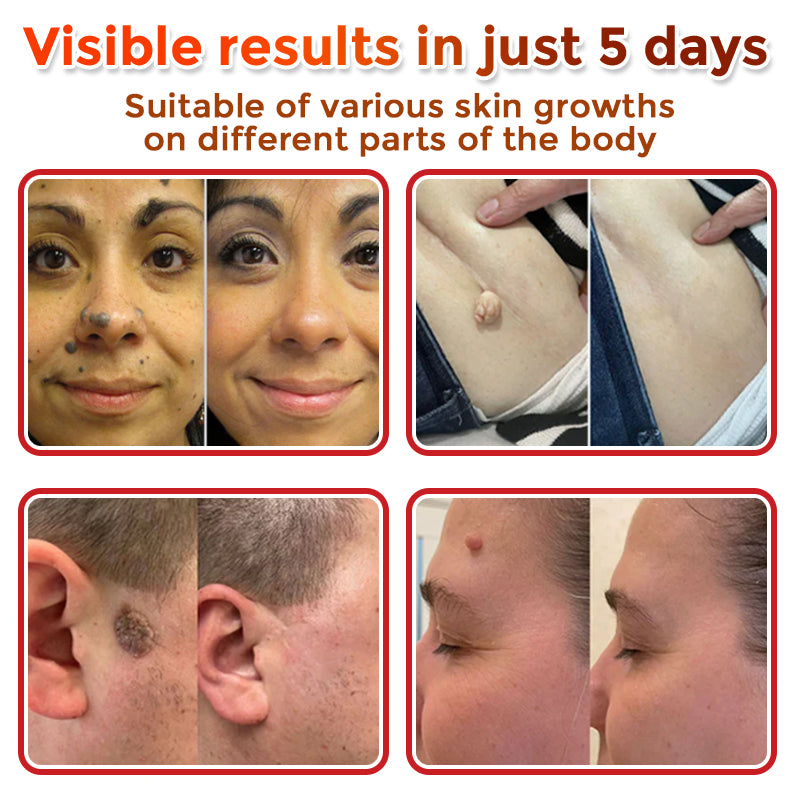 🌈🌈GFOUK® MicroNeedle Botanic Skin Tag Removal Patch 🇺🇸 Made in the USA💕
