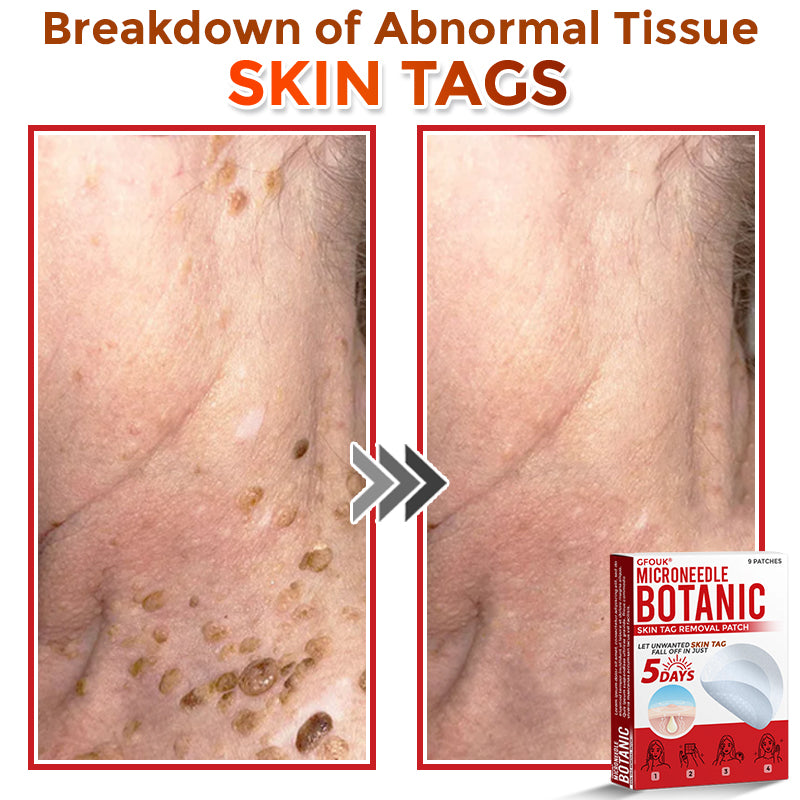 🌈🌈GFOUK® MicroNeedle Botanic Skin Tag Removal Patch 🇺🇸 Made in the USA💕