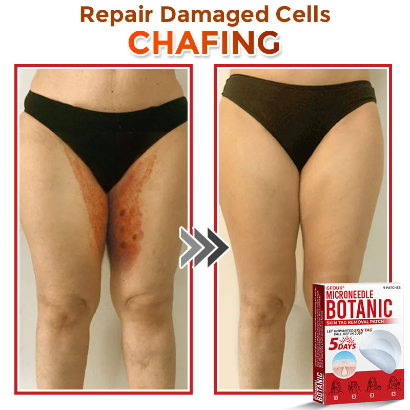 🌈🌈GFOUK® MicroNeedle Botanic Skin Tag Removal Patch 🇺🇸 Made in the USA💕