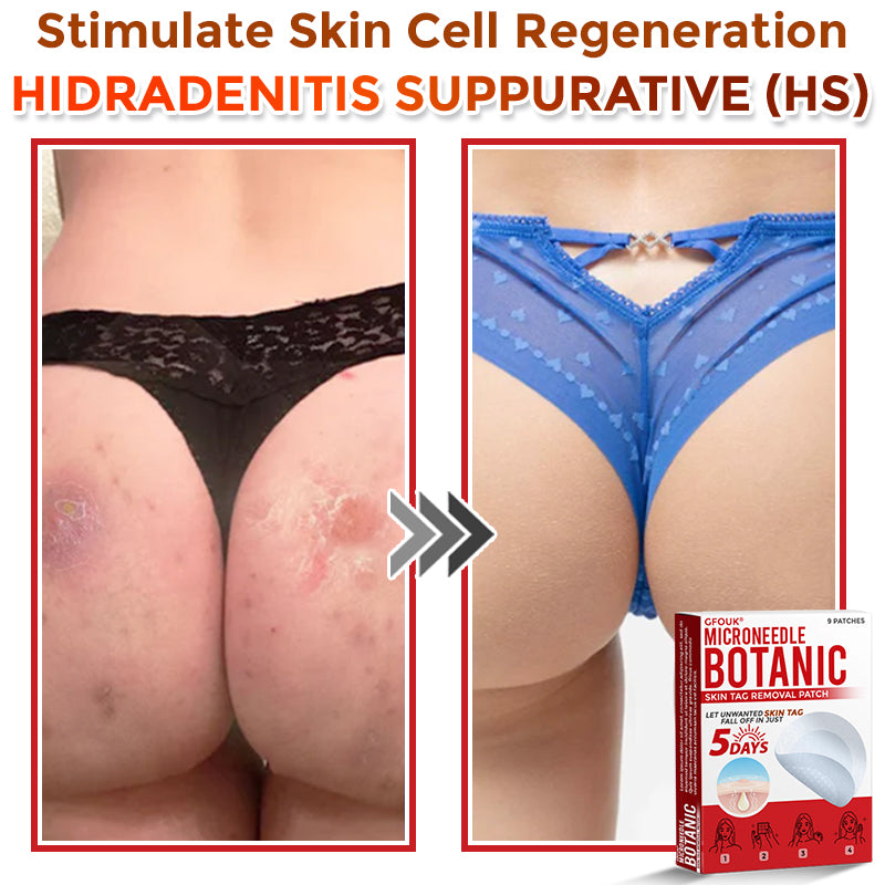 🌈🌈GFOUK® MicroNeedle Botanic Skin Tag Removal Patch 🇺🇸 Made in the USA💕