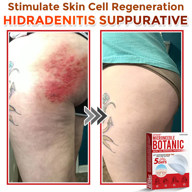 🌈🌈GFOUK® MicroNeedle Botanic Skin Tag Removal Patch 🇺🇸 Made in the USA💕