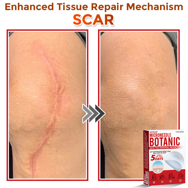 🌈🌈GFOUK® MicroNeedle Botanic Skin Tag Removal Patch 🇺🇸 Made in the USA💕