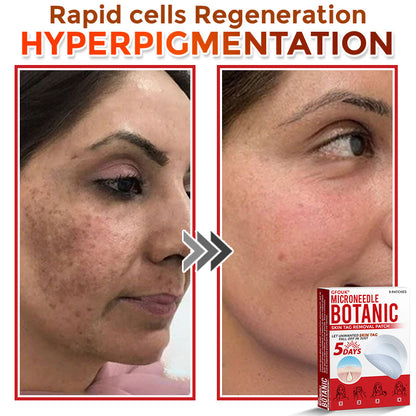 🌈🌈GFOUK® MicroNeedle Botanic Skin Tag Removal Patch 🇺🇸 Made in the USA💕