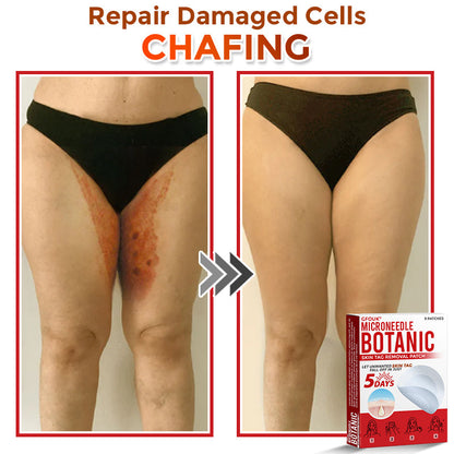🌈🌈GFOUK® MicroNeedle Botanic Skin Tag Removal Patch 🇺🇸 Made in the USA💕