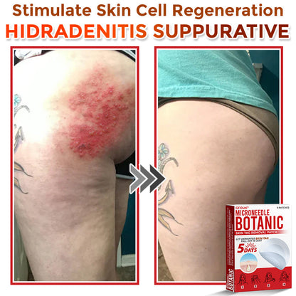🌈🌈GFOUK® MicroNeedle Botanic Skin Tag Removal Patch 🇺🇸 Made in the USA💕